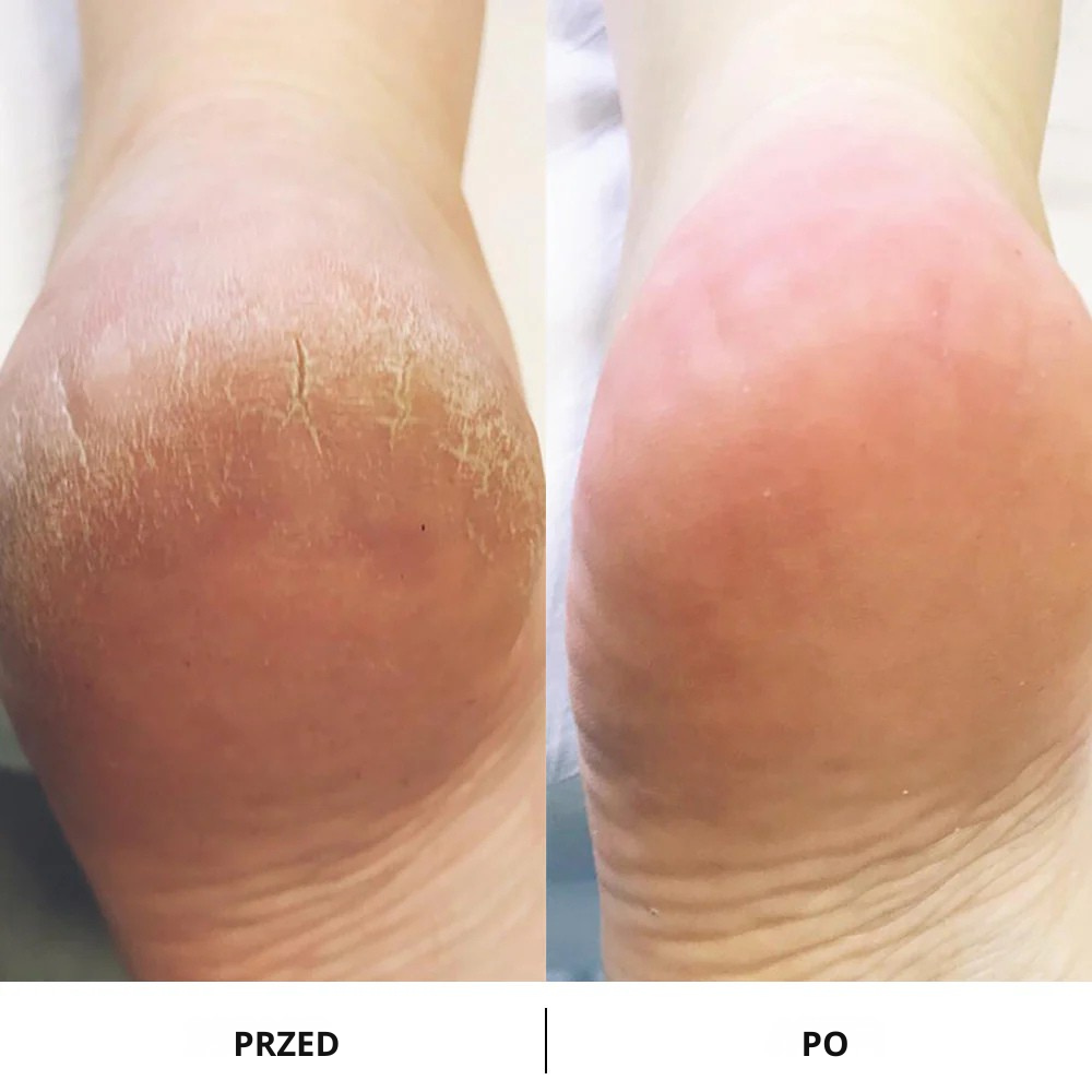 Selviora pilnik elektryczny do stóp - Gładkie stopy w mgnieniu oka!